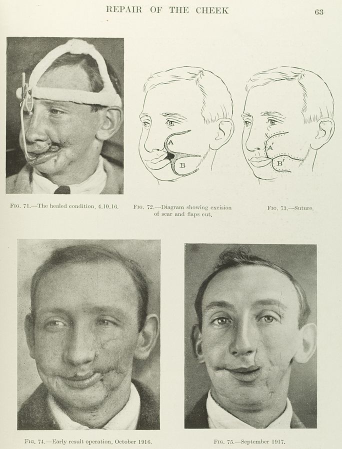 A textbook page showing three photographs of a man with two drawings detailing a facial reconstruction surgery of the cheek