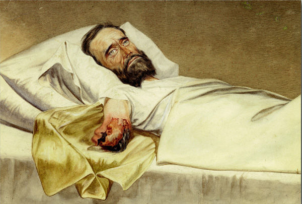 White man with beard lays on a bed with his right arm outstretched. The right arm has been maimed badly and is missing below the shoulder. The wound is dark and red, and the skin is torn apart.
